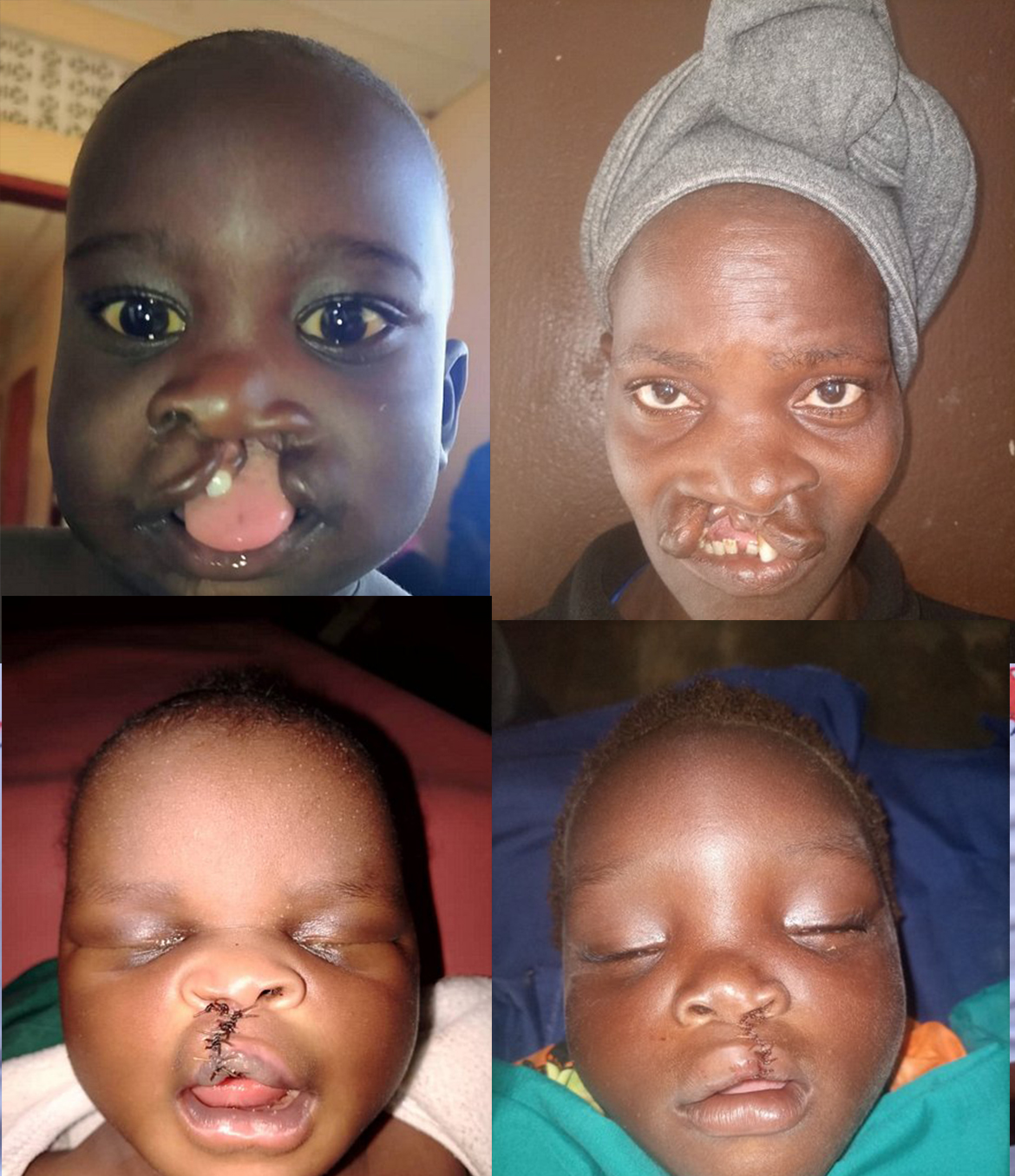 OHAI Brings Smiles to Over 100 Cleft Patients in IDP Camps in November 2022