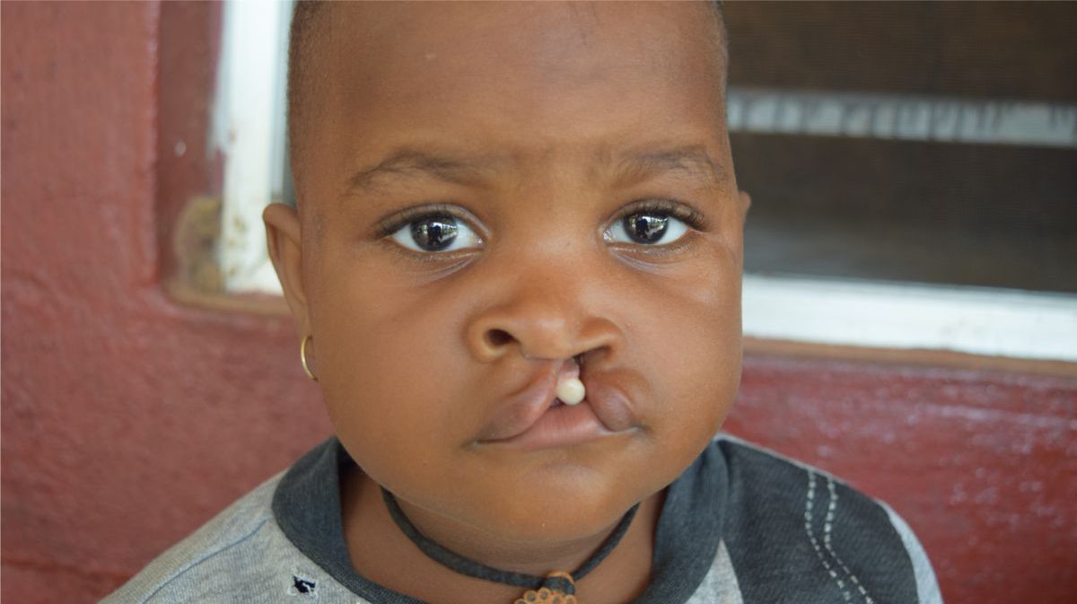 cleft lip patient