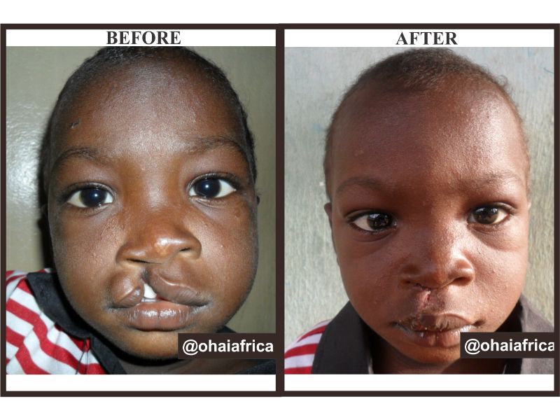 OHAI Sets record; Performs 174 Surgeries in 4 Weeks