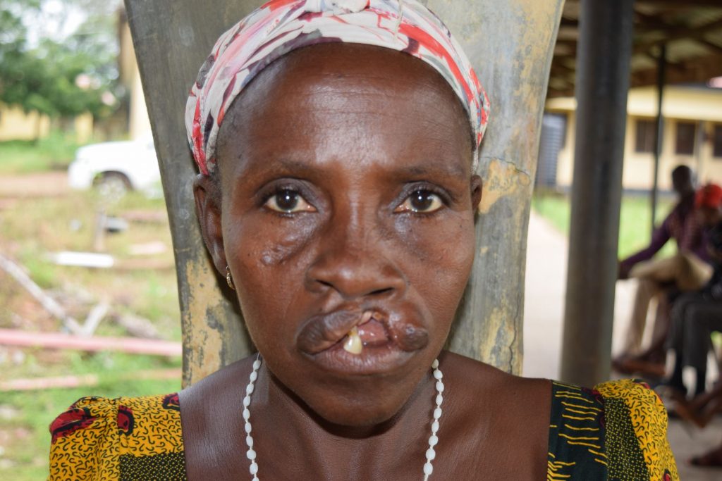 John's mother before her cleft lip surgery
