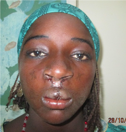 Saudo immediately after cleft lip surgery - ohai africa